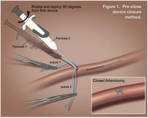 Percutaneous TEVAR (ptevar) First description of 6Fr Perclose ProGlide systems exclusively in trauma patients Final 10 consecutive patients in the series treated percutaneously No