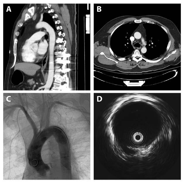 The Utility of Intravascular Ultrasound Compared to Angiography in the Diagnosis of Blunt Traumatic Aortic Injury A Azizzadeh, J Valdes, CC Miller, LL Nguyen, AL Estrera, K