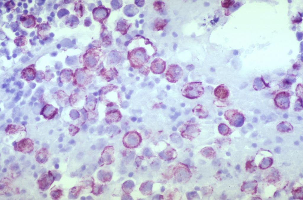 Illustration I - Rhabdomyosarcoma cells in effusion