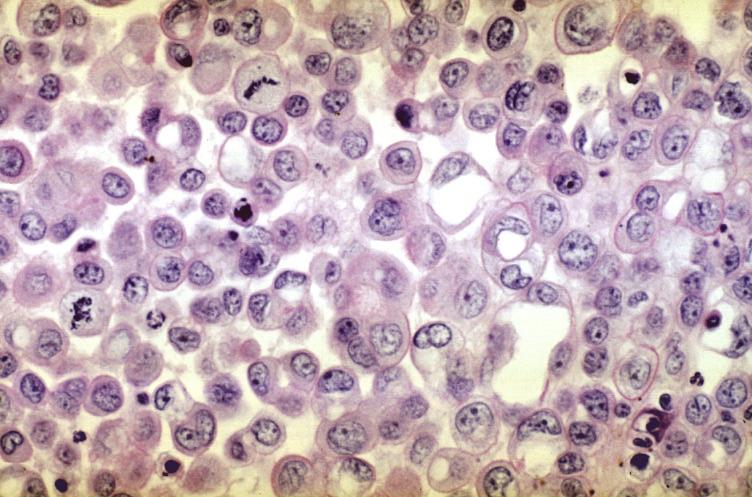Illustration L - Negative mucin stain(on cell block) of