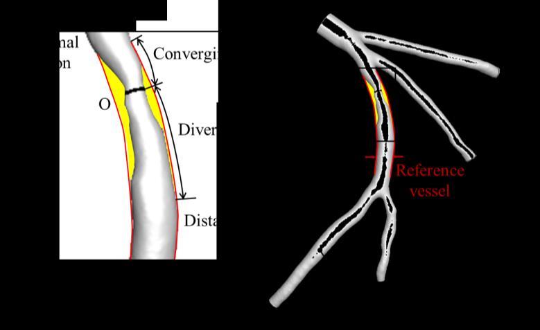 Schrauwen et al. [6, 7] estmated the pressure drop n stenotc coronary arteres based on ther patentspecfc geometres.