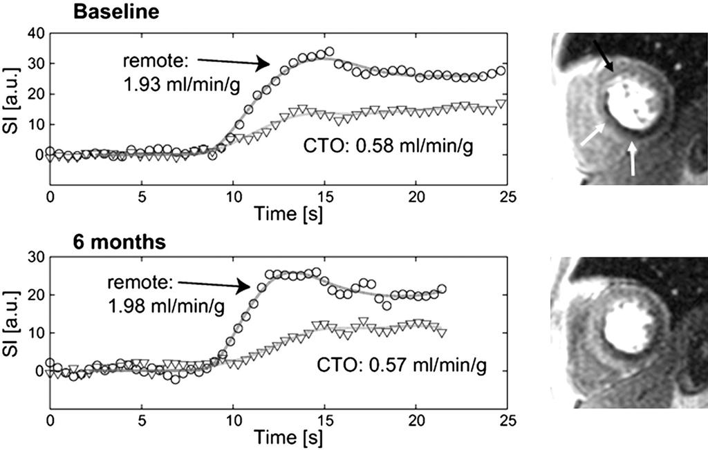 Shifting Focus Downstream from CTOs Insights to Myocardial Recovery Following CTO Recanalization Signal Intensity-Time Curves and