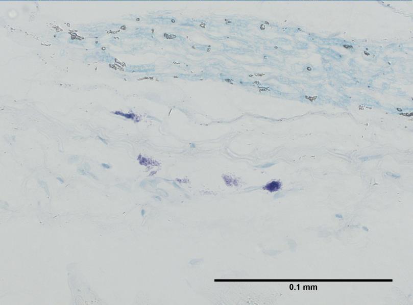 Figure 1. Microscopic appearance of degranulated and non-degranulated mast cells present in skeletal muscle tissue stained with Toluidine blue (x400).