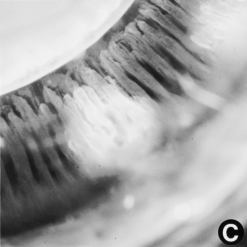 Perforation of the sclera was not observed after TSCPC at any level of exposure power. One week after surgery. At 600 mw, spindleshaped cells were stratified at the surface of the lesion.