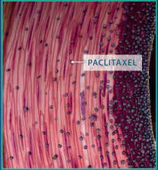 the blood Urea hydrates causing the release of paclitaxel Paclitaxel binds to the wall due to its hydrophobic and lipophilic properties Paclitaxel