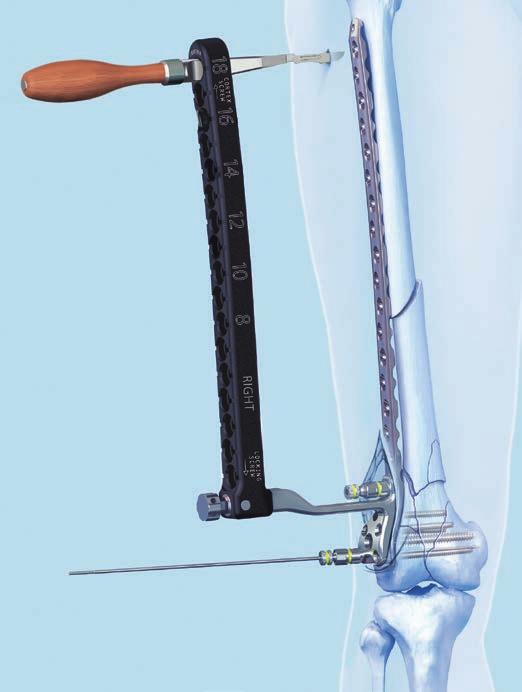 Optional instrument 03.120.016 Scalpel Handle for Periarticular Aiming Arm Instruments Attach a blade to the scalpel holding end of the handle.