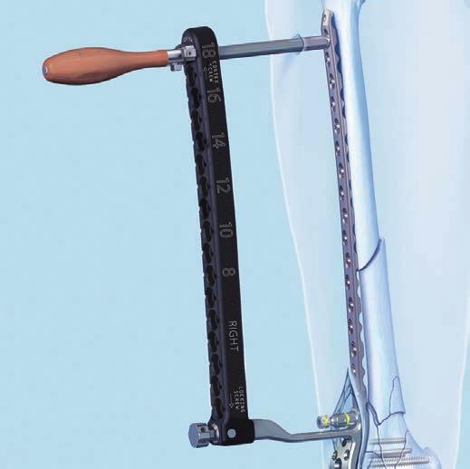 Surgical Technique Insert the trocar with handle into a guide