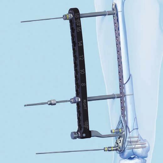 9 Use of pull reduction device (optional) Instruments 03.120.014 Guide Sleeve for Periarticular Aiming Arm Instruments 03.120.023 Pull Reduction Device for Percutaneous Drill Guide B 4.