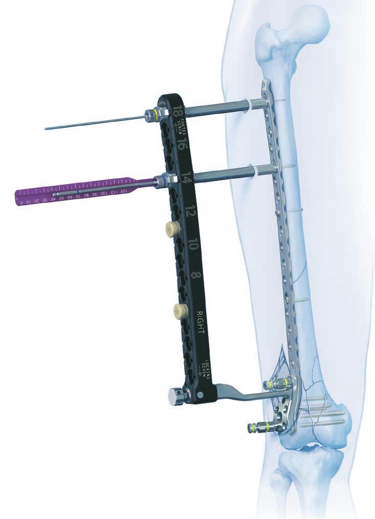 Periarticular Aiming Arm Instruments for LCP Condylar Plate 4.5/5.0. Part of the LCP Periarticular Aiming Arm Instrument System (large).