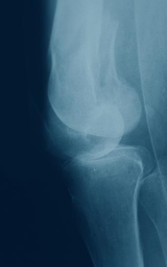 the femur Fractures in normal or osteopenic bone Contraindications No specific