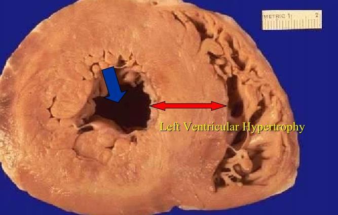Left ventricular hypertrophy The left ventricle is markedly thickened in this patient with severe