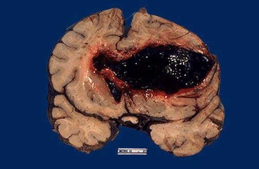 The large hemorrhage in this adult brain arose in the basal ganglia