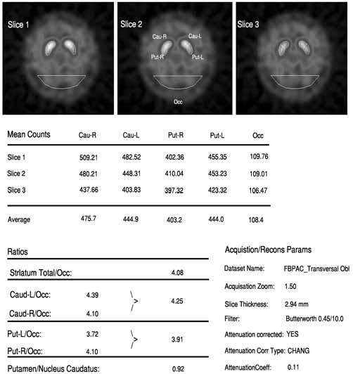 Nuclear Medicine Review 2008, Vol. 11, No. 2 A B Figure 2. Exemplary reports of semiquantitative analysis of 3 selected transversal slices of DaTSCAN images. A. Reconstructed by FBP method. B. Reconstructed by OSEM method.