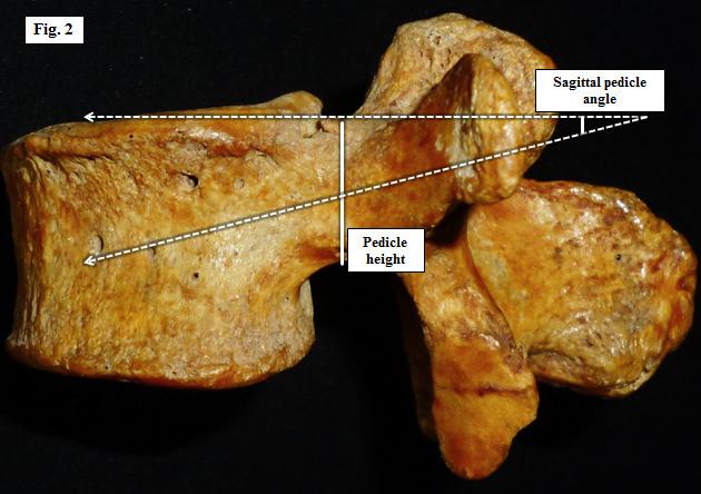 vertebral body border in junction of the superior facet and the transverse the sagittal plane. process to the anterior cortex of the vertebral body 5.