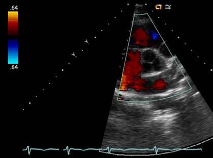 Doppler Echocardiography Color Flow Doppler Pulse wave modality that cannot resolve high velocities Turbulence/variance maps can help define jet, direction and turbulence Pulse Wave Spectral Doppler