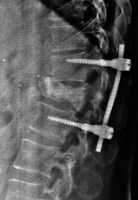 ) plain X-rays 2 weeks after vertebroplasty