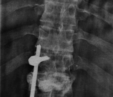 ) plain X-rays 2 months after vertebroplasty 367