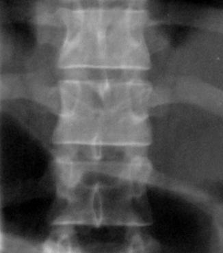 ) plain X-rays, 2 months postoperative Figure 9 Case