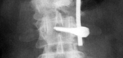 Figure 17 shows the aspect obtained, 2 weeks after vertebroplasty.
