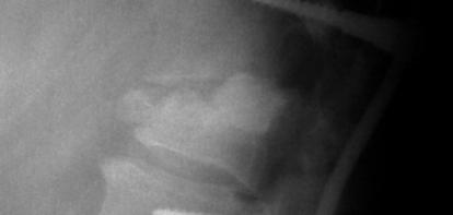 ) plain X-rays 2 months postoperation Figure 17 Case 3 (N.G.
