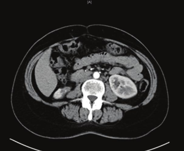 2 Case Reports in Medicine (c) (d) (e) (f) Figure 1: Preoperative contrasted CT scans of the patient, showing multiple bilateral kidney tumors, with diameters ranging between 1 and 5 cm.