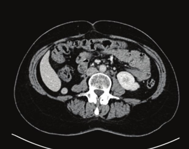 Case Report A 56-year-old woman presented with bilateral multiple kidney tumors, diagnosed radiologically during her evaluation for hematuria.