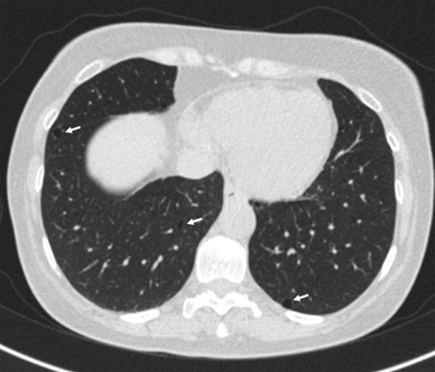 Case Reports in Medicine 3 Axial CT images show small cysts randomly distributed Intervening lung parenchyma appears normal (c) Coronal image reconstructed with minimum intensity projection technique