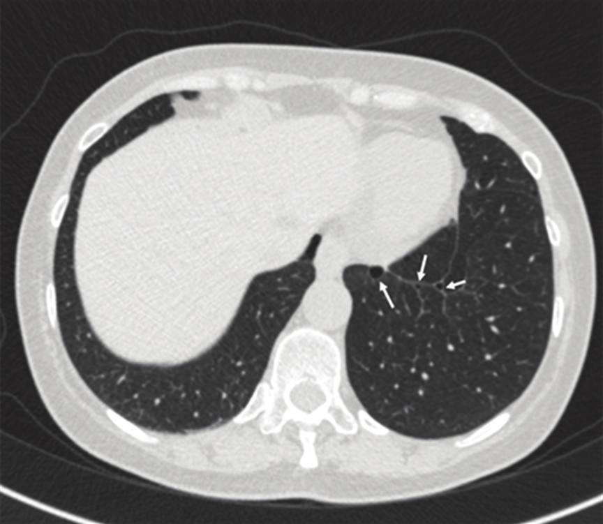 reconstructed with minimum intensity projection technique, showed small cysts; most of them clustered in the right upper lobe. No pneumothorax was identified.