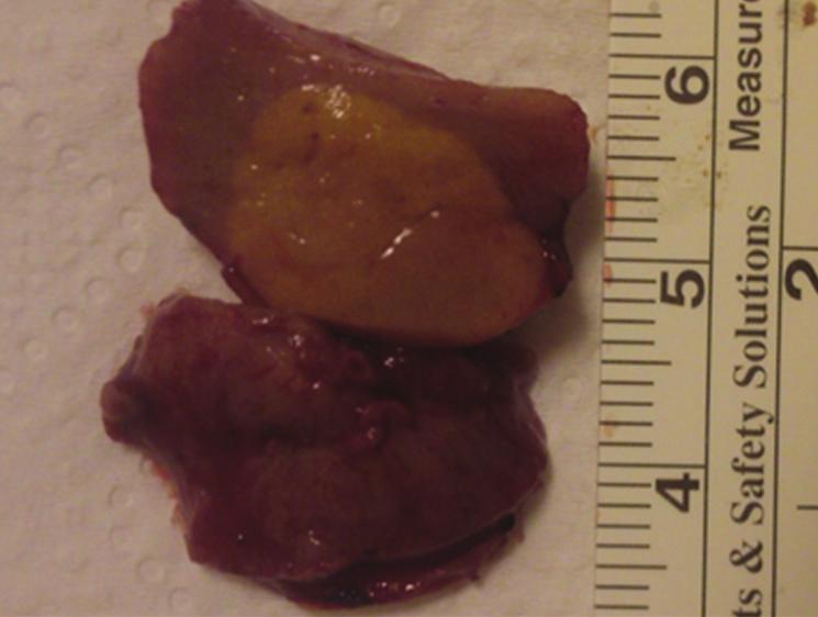 The left kidney was treated 6 weeks after the first stage. Using the same, open, no-ischemia NSS technique, a total of 4 tumors were enucleated from the left kidney.