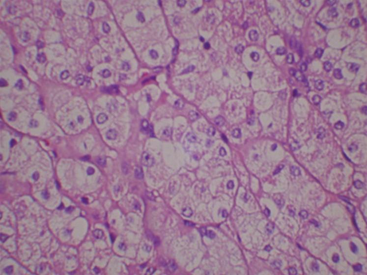Case Reports in Medicine 5 Figure 5: Microscopic views of H&E sections, demonstrating histological features of both oncocytoma and conventional variant of renal cell carcinoma.