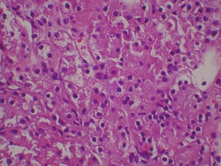 familial leiomyomatosis, and hereditary papillary renal cell carcinoma usually presenting with bilateral multiple tumors, constitute challenges [9, 11].