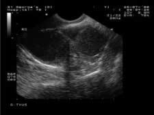 A transvaginal ultrasound scan was performed in all women undergoing surgery for a suspected endometrioma or benign cystic teratoma.