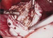 Table 2 Details of false positive endometrioma data Figure 5 Laparoscopic view of the internal pseudocapsule of an ovarian endometrioma after drainage of the cyst contents, prior to electro/laser