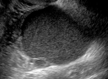 Ultrasound Appearance of Ovarian Endometrioma Diffuse, homogeneous low to medium level