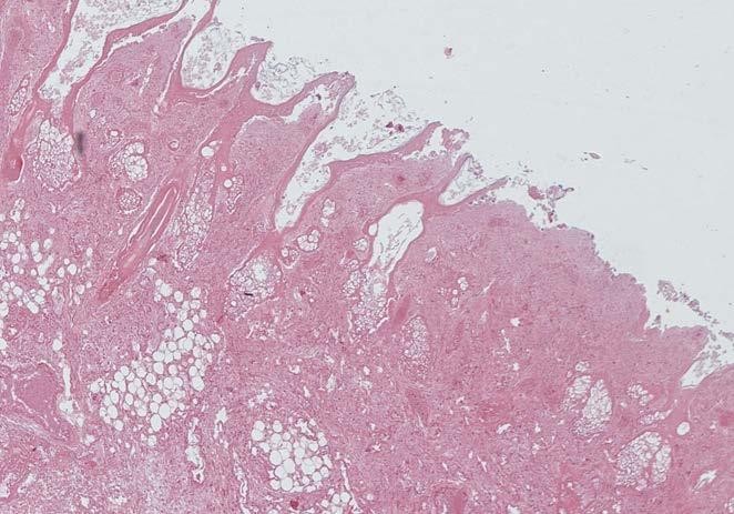 Mature Cystic Teratoma Derive from ovarian germ cells Contains multiple germ