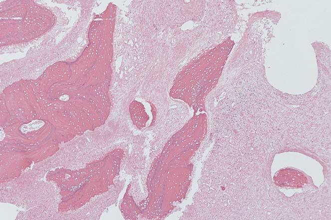 Mature Cystic Teratoma Derive from ovarian germ cells Contains multiple germ call