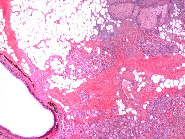 Mature Cystic Teratoma Derive from ovarian germ cells Contains multiple germ call layers: Ectoderm
