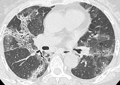 underlying fibrosis A C B D Fig 3.