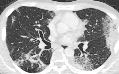 (A) Chest radiograph shows ill-defined patchy