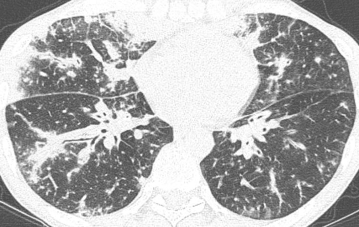 Churg-Strauss syndrome in a 47- year-old man with cough, weight loss