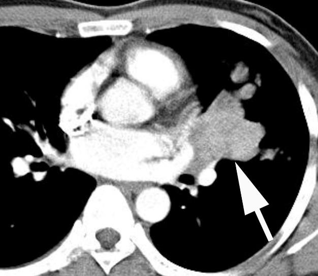 3-2) Eosinophilic Lung Disease with Known Causes Bronchocentric granulomatosis (BG) Necrotizing granulomatous inflammation centered around bronchioles and small bronchi Commonly associated with