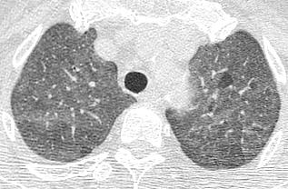 diffuse GGO with ill-defined