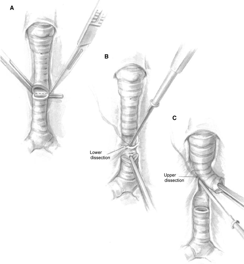 188 P.B. Manning Figure 4 The trachea is divided at mid-stenosis, and this allows anterior traction on each segment to facilitate posterior dissection of each tracheal segment.