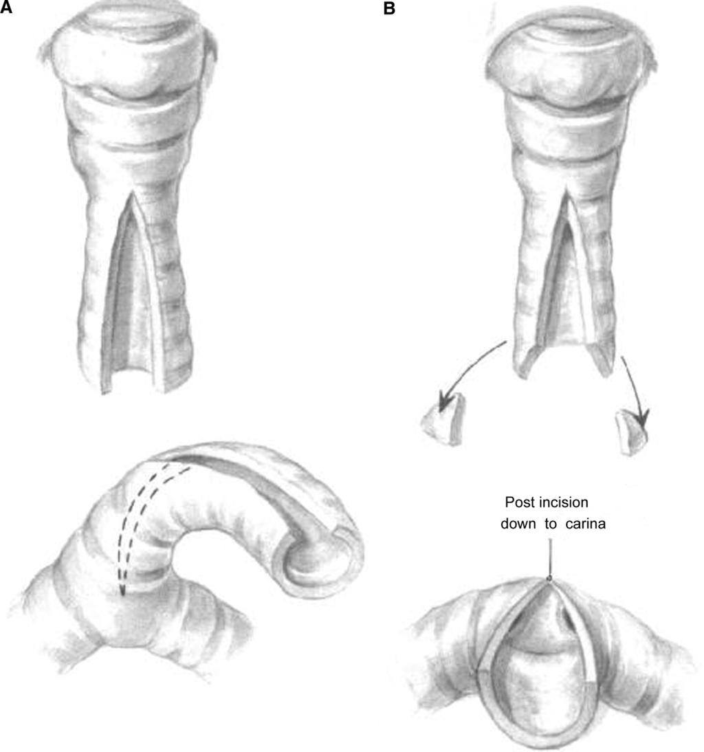 Slide tracheoplasty for congenital tracheal stenosis 189 Figure 5 Longitudinal incision is made in opposite surfaces (anterior and posterior midline) of each tracheal segment.