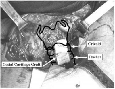 The cuffs of tubes accounted for 12 lesions. Eight of these patients had an endotracheal intubation only. Duration of the intubation was 10.5 (2 14) days.