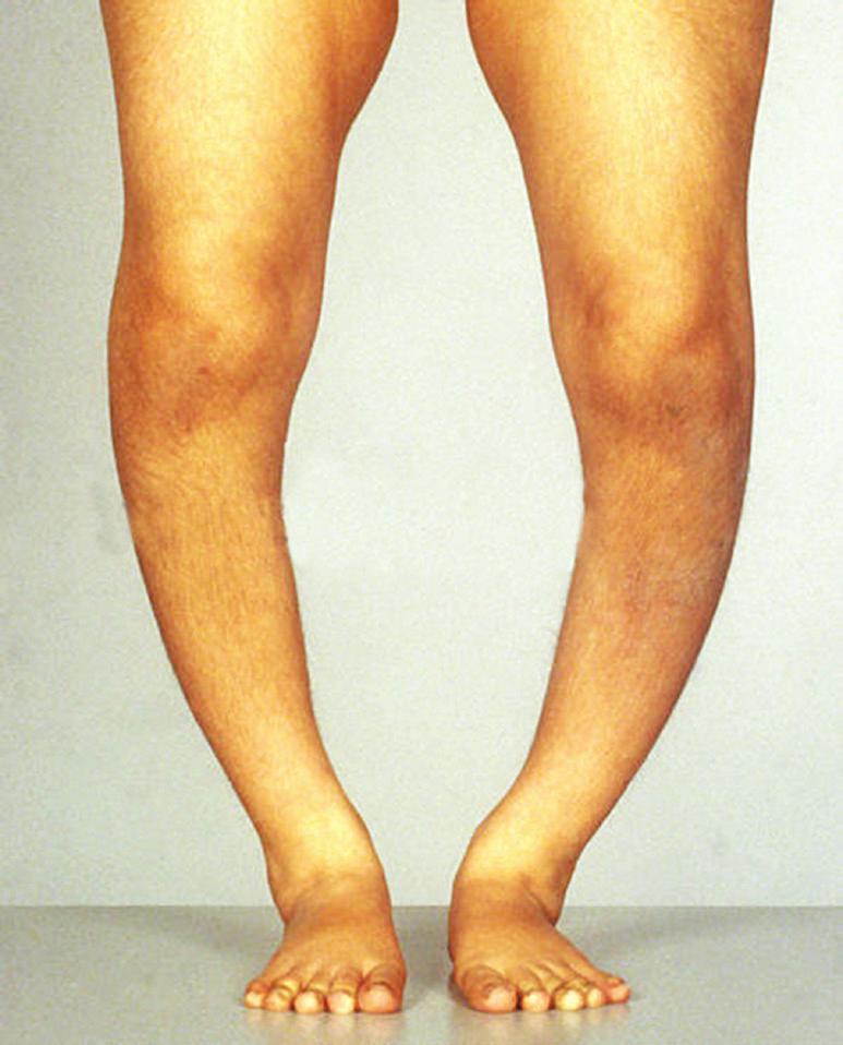 3. MARASMUS The picture kept for identification depicts Marasmus. Comments: It is a disorder due to protein deficiency in children. It is an acute form of protein malnutrition.