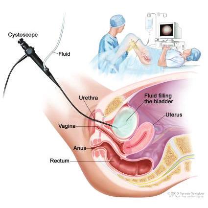 Figure 2. Examination of the bladder www.uchospitals.edu/online-library This is a day case procedure. You will be asked to come to hospital on the day you are to have the Botox injections.