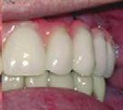 of the edentulous ridge. If the transition line is apical to the smile line, an esthetic outcome is predictable.