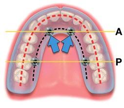 In the resorbed maxilla The resorption pattern of the maxilla (dictated by the black line in figure 3) may not allow for the placement of six implants. Therefore, four implants are placed.