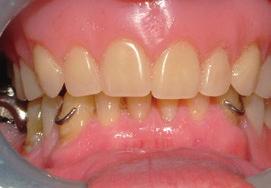 He complained about the decreased retention and was often worried about the falling out of the denture. The patient s requirement was to replace the removable upper denture with a fixed restoration.